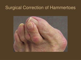 Surgical Correction of Hammertoes