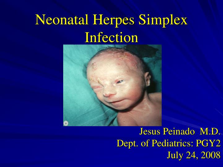 neonatal herpes simplex infection