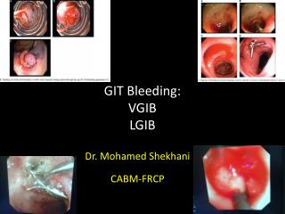 GIT Bleeding: VGIB LGIB