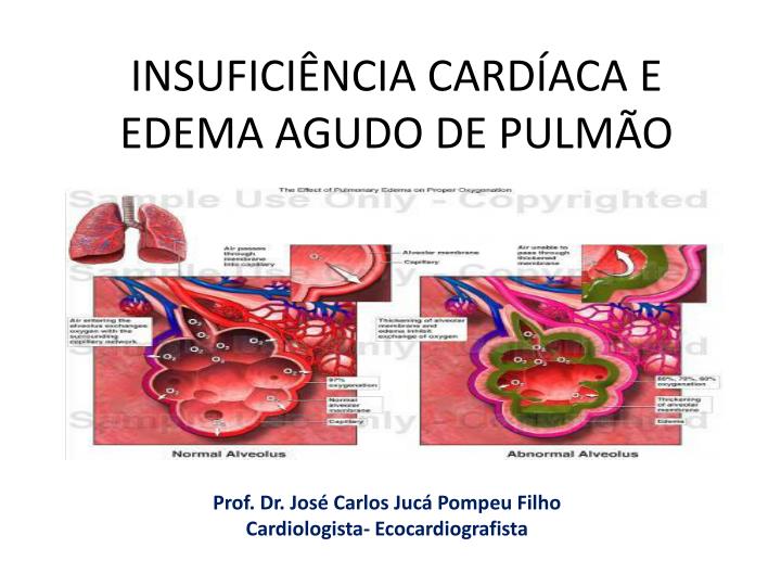 PPT INSUFICIÊNCIA CARDÍACA E EDEMA AGUDO DE PULMÃO PowerPoint Presentation ID