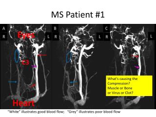 ms patient 1