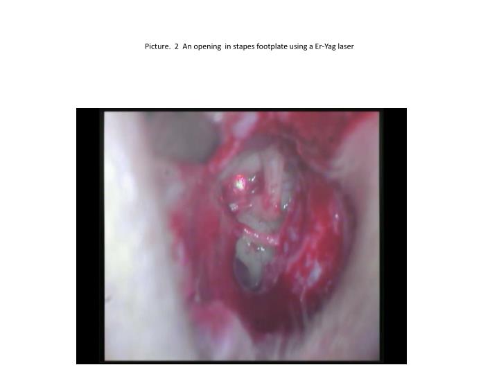 p icture 2 an opening in stapes footplate using a e r yag laser