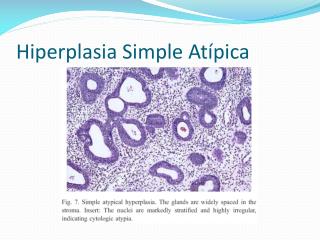 hiperplasia simple at pica