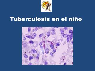 tuberculosis en el ni o