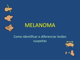 melanoma
