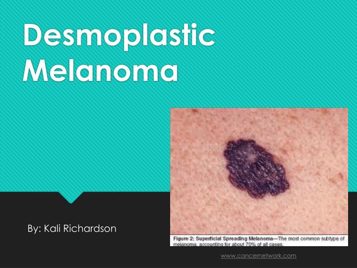 desmoplastic melanoma