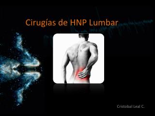 cirug as de hnp lumbar