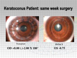 Keratoconus Patient: same week surgery