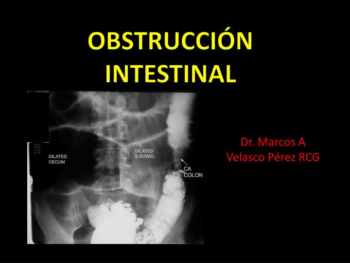 obstrucci n intestinal