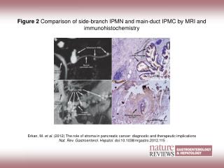Figure 2 Comparison of side-branch IPMN and main-duct IPMC by MRI and immunohistochemistry