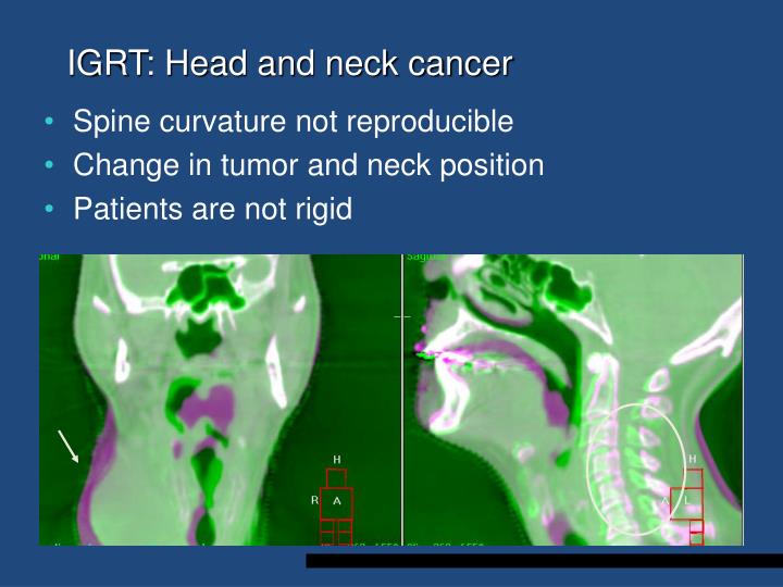igrt head and neck cancer