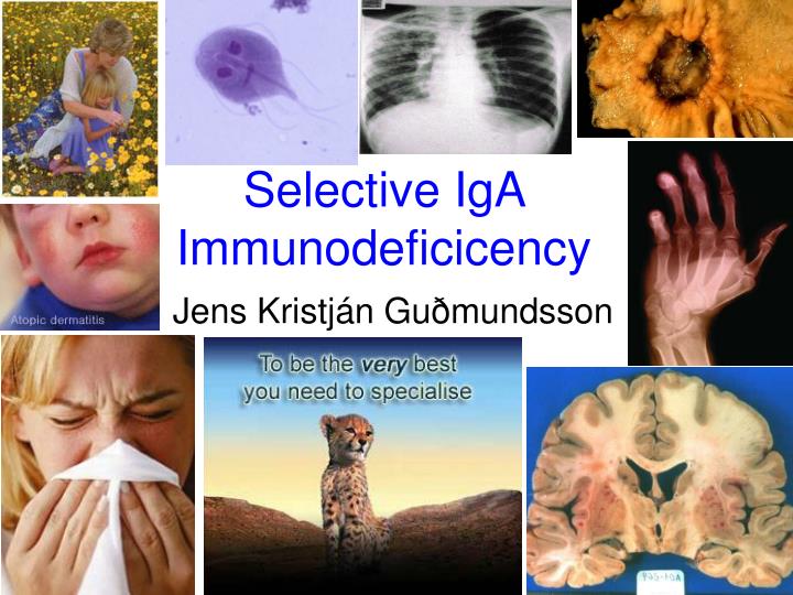 selective iga immunodeficicency