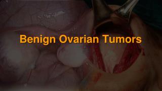 Benign Ovarian Tumors