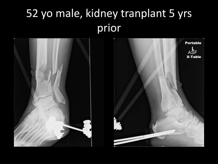 52 yo male kidney tranplant 5 yrs prior