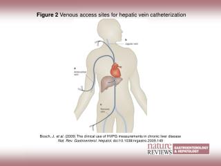Figure 2 Venous access sites for hepatic vein catheterization