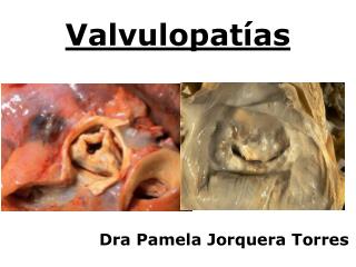 valvulopat as