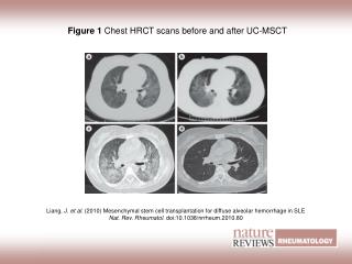 Figure 1 Chest HRCT scans before and after UC-MSCT