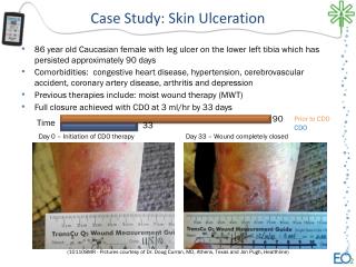 Case Study: Skin Ulceration