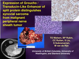 Expression of Groucho / Transducin-Like Enhancer of split protein distinguishes synovial sarcoma