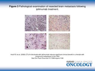 Figure 3 Pathological examination of resected brain metastasis following ipilimumab treatment.
