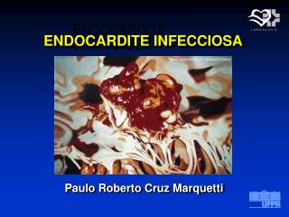 endocardite infecciosa