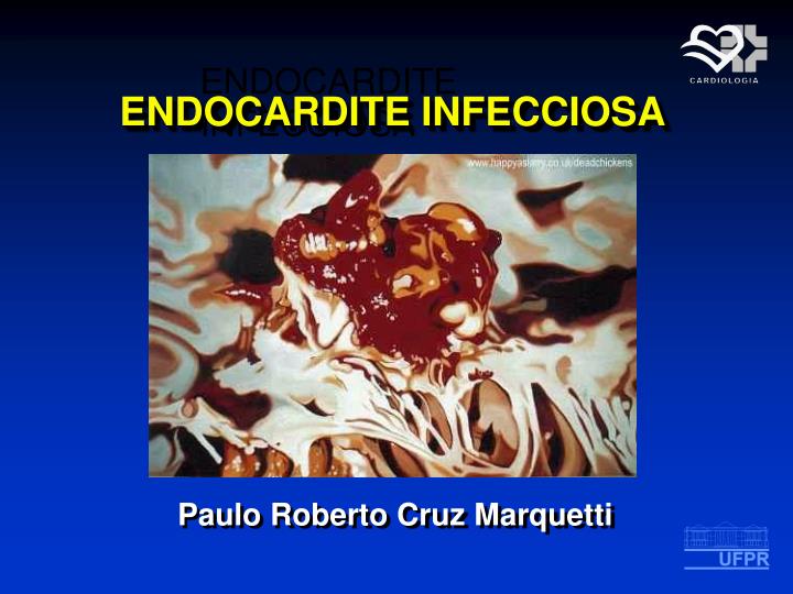 endocardite infecciosa