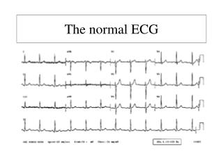 The normal ECG