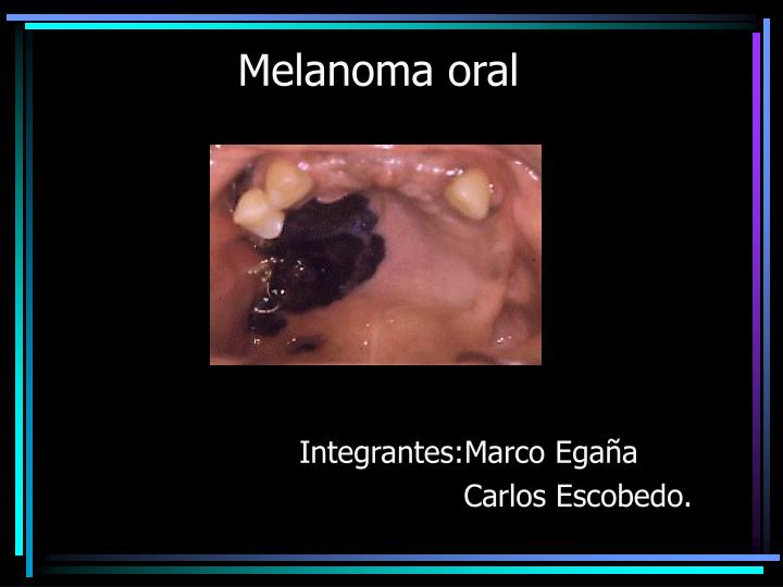 melanoma oral