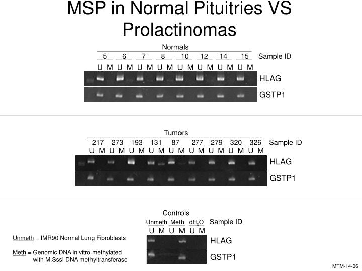 msp in normal pituitries vs prolactinomas