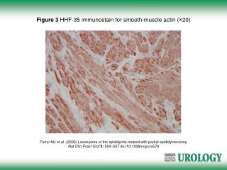 Fumo MJ et al. (2006) Leiomyoma of the epididymis treated with partial epididymectomy