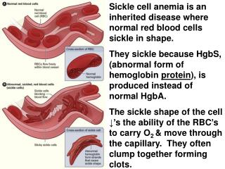 Sickle cell anemia is an inherited disease where normal red blood cells sickle in shape.