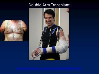 Double Arm Transplant