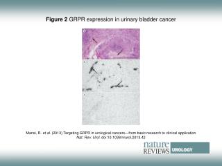 Figure 2 GRPR expression in urinary bladder cancer