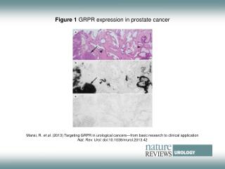 Figure 1 GRPR expression in prostate cancer