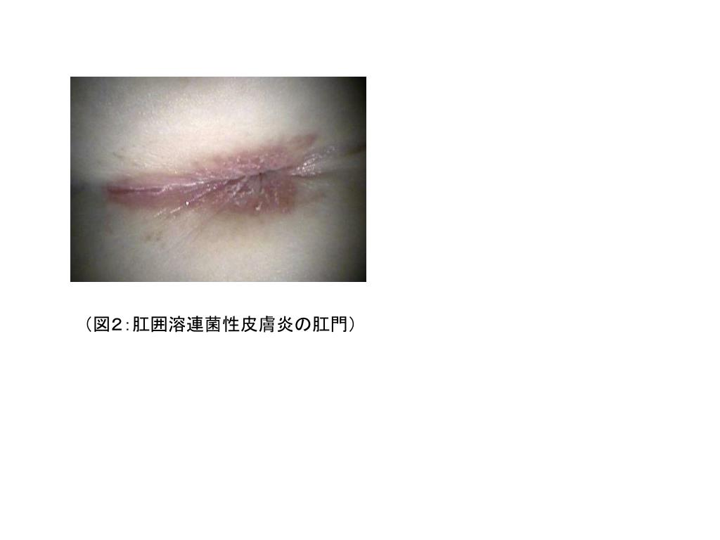 肛門周囲のかゆみ | 肛門が痒いのはなぜ , 肛門のかゆみについて|市民のみなさまへ|日本大腸肛門病学会 – MMEC