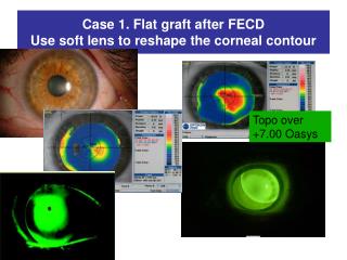 Case 1. Flat graft after FECD Use soft lens to reshape the corneal contour