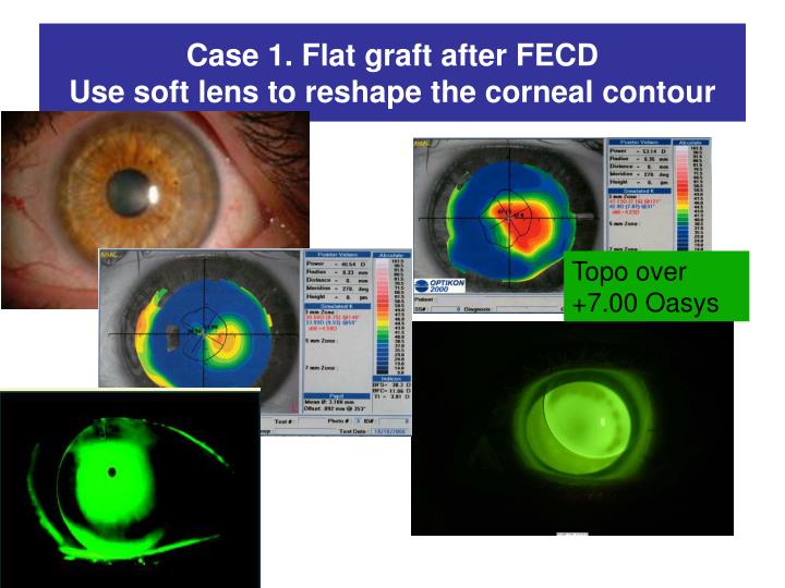 case 1 flat graft after fecd use soft lens to reshape the corneal contour