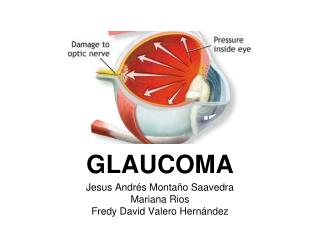 glaucoma