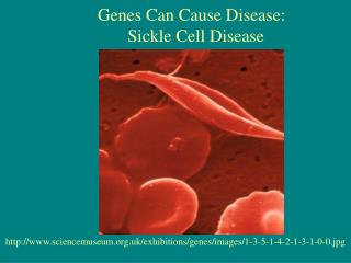 Genes Can Cause Disease: Sickle Cell Disease