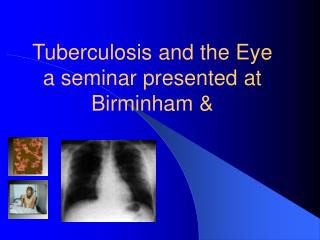 Tuberculosis and the Eye a seminar presented at Birminham &amp;